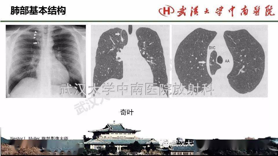 肺部影像解剖及基本概念,基本病变