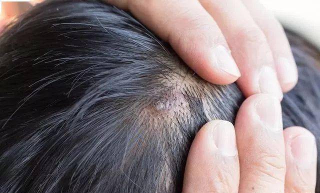头皮痒,还容易长红色小疙瘩?帮你揪出5个原因!
