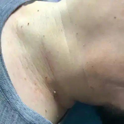 闫玉红健康课堂|脖子上长"小肉粒",竟是病毒感染!