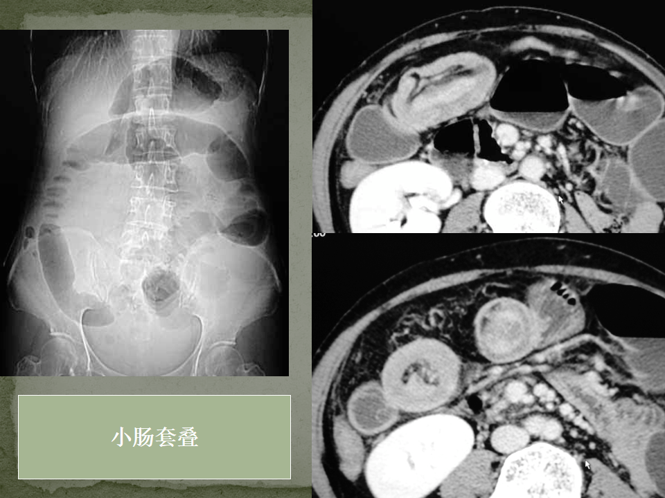 ct入门 | 肠梗阻的ct影像诊断