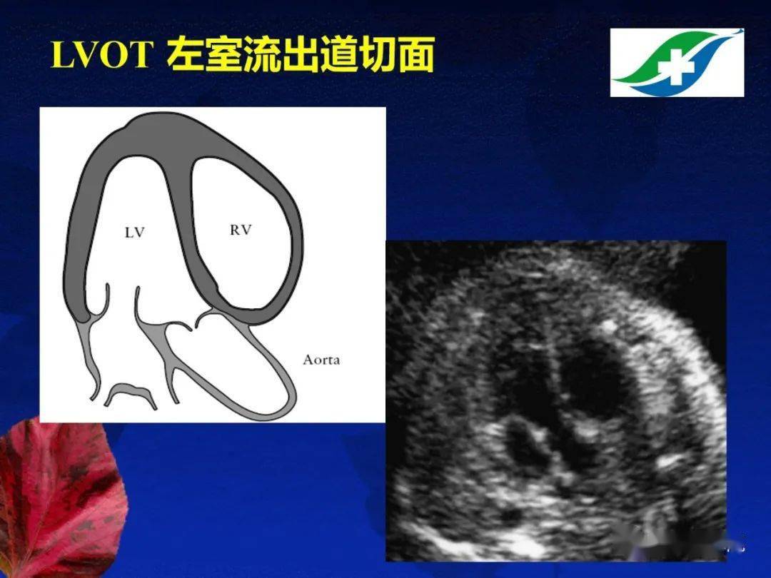 胎儿超声心动图基础及切面