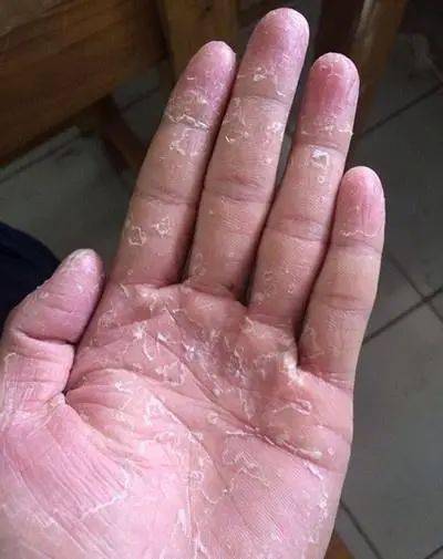 手癣:俗称" 鹅掌风" ,是指由皮肤癣菌引起的手部皮肤浅表真菌感染.