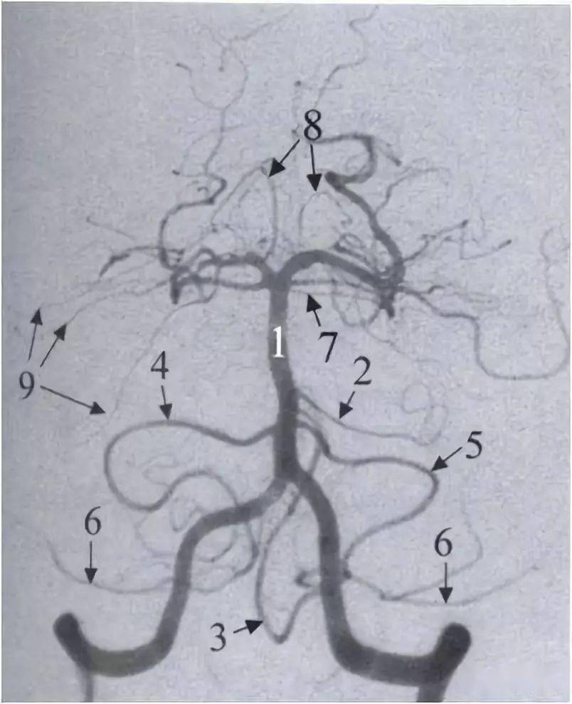 脊髓前动脉 4.小脑后下动脉(pica) 5.基底动脉 6.