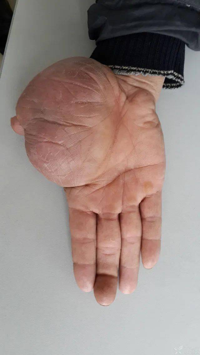 简要病史:中指远节指间关节外伤 2 小时.既往拇指肿物 4  余年.