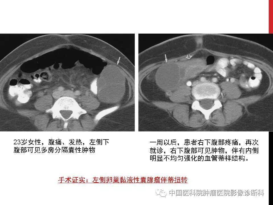 简便,快捷(异位妊娠破裂出血,卵巢黄体囊肿破裂出血,观察盆腔积液情况