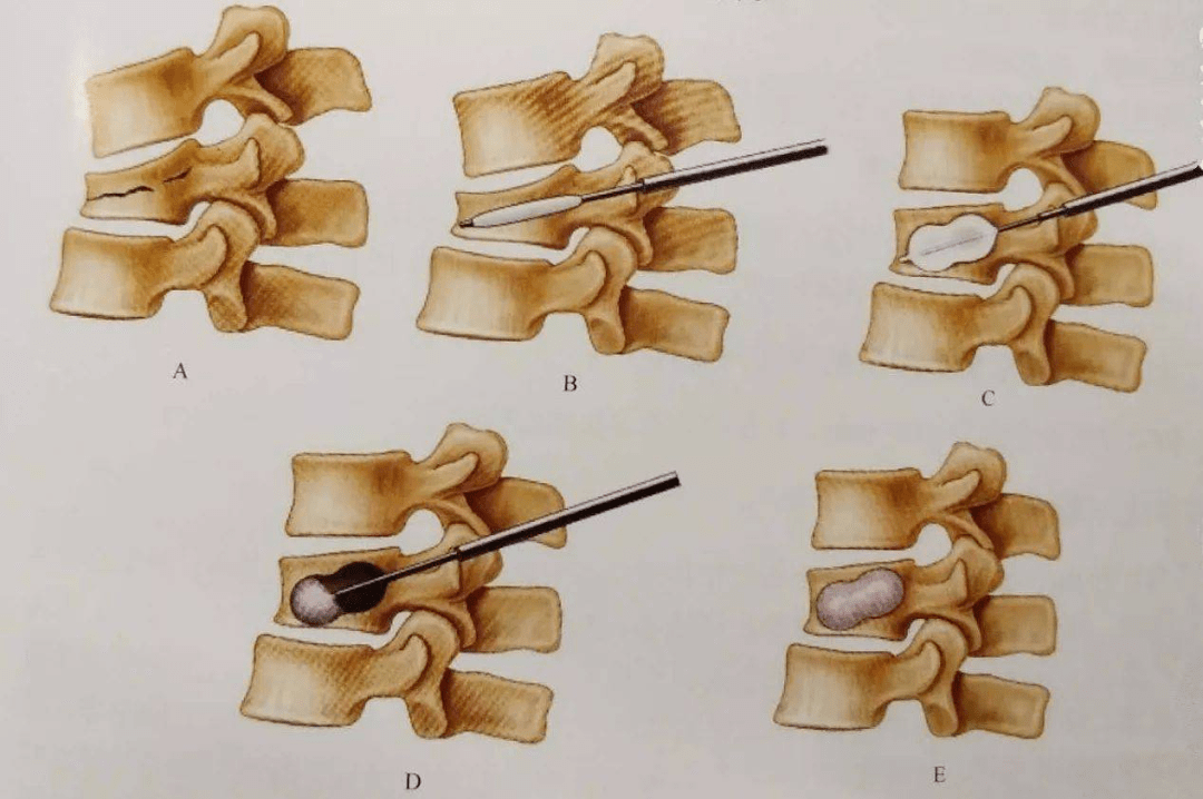 p art 02 "骨水泥"微创手术叫做"经皮椎体成形术",治疗时,在骨折部位