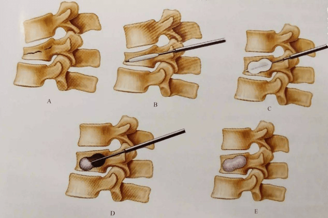 随着医学技术的进步,"骨水泥"微创手术成为了这类患者一个比较好的