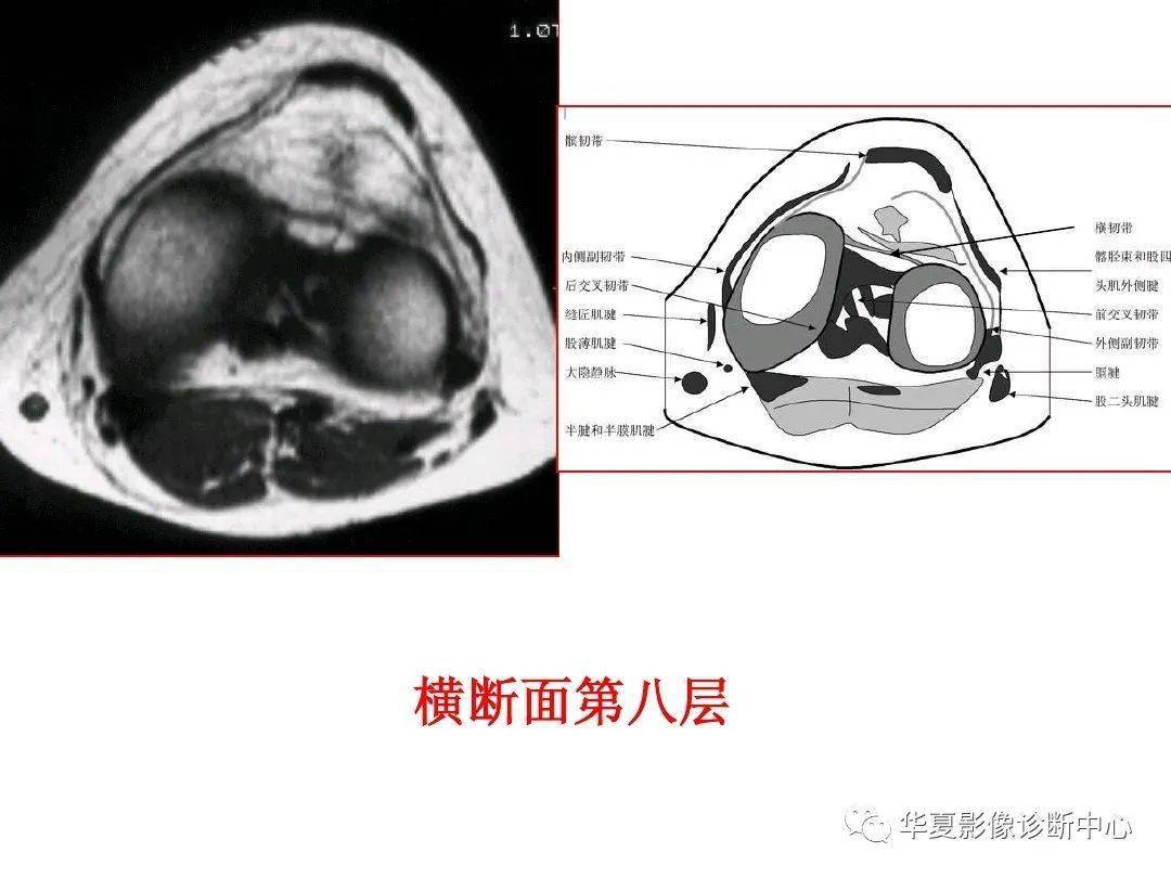 交叉韧带解剖及损伤的mri诊断