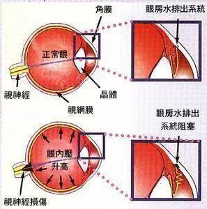 对于青光眼,眼科医生这样比喻:青光眼眼睛就像一个在涨水的湖泊,如果