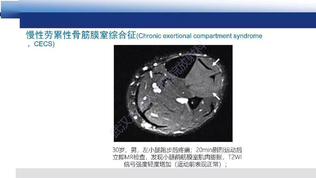 肌肉创伤mr诊断解剖生物力学病理生理学及影像学表现