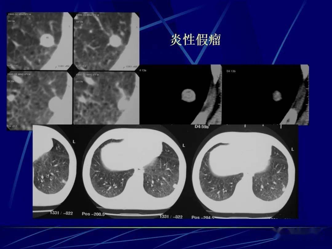 肺小结节影像诊断