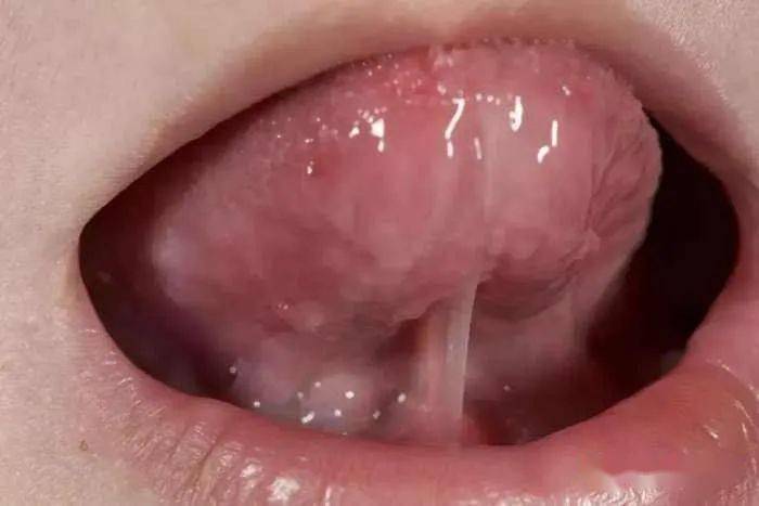 含乳疼痛,确认下宝宝是否有舌系带异常