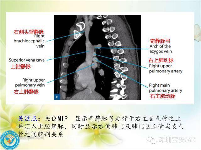 推荐丨肺动脉和肺静脉影像断层解剖