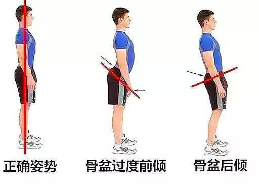 骨盆后倾 ,这一种姿势也是肌肉不平衡等因素造成的.