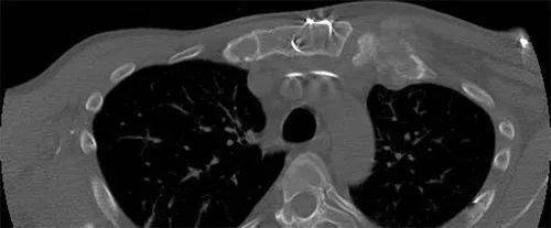 肋骨病变ct总结多图