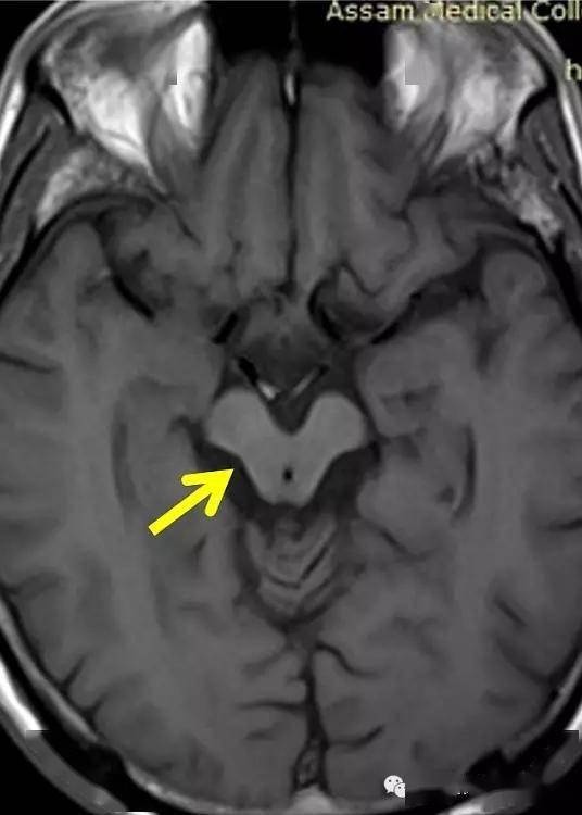 2. 中脑萎缩,大脑脚盖变凹(黄色箭头)