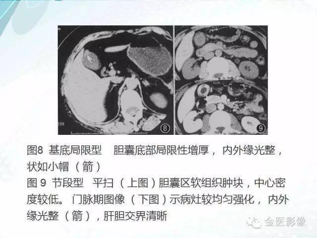 胆囊腺肌症影像表现及鉴别