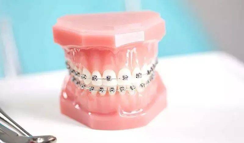 牙齿矫正,为什么需要按时复诊呢?