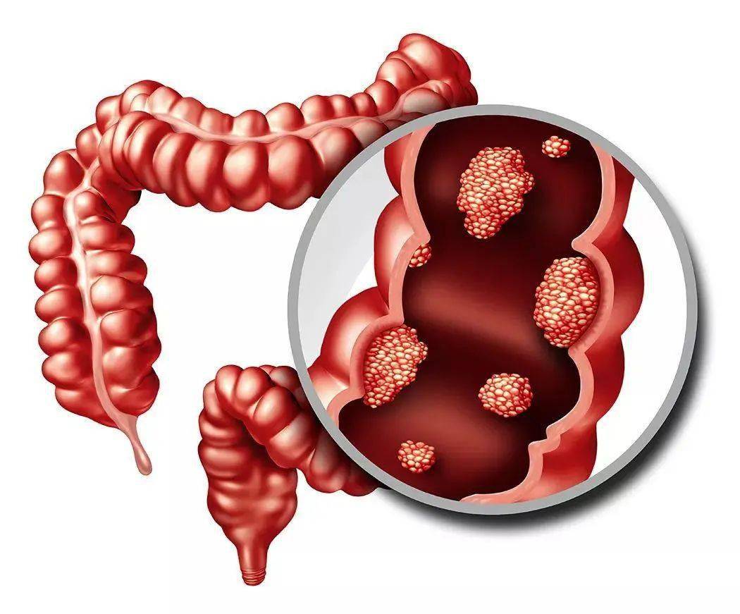 如果大便中经常带有血丝,就要引起足够的重视,很可能就是肠道中已经有