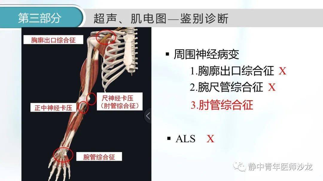 原创肘管综合征一例