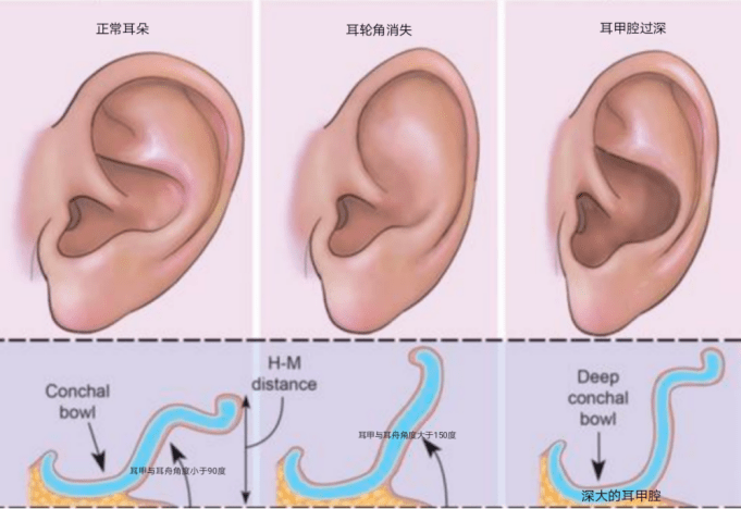 耳甲过度发育,对耳轮形成欠佳甚至完全消失,耳郭上半部形态扁平