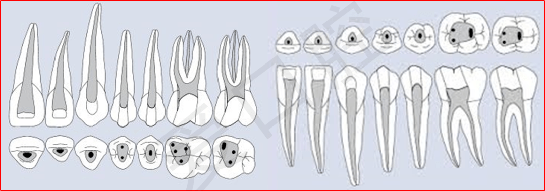 全口牙齿开髓洞型图