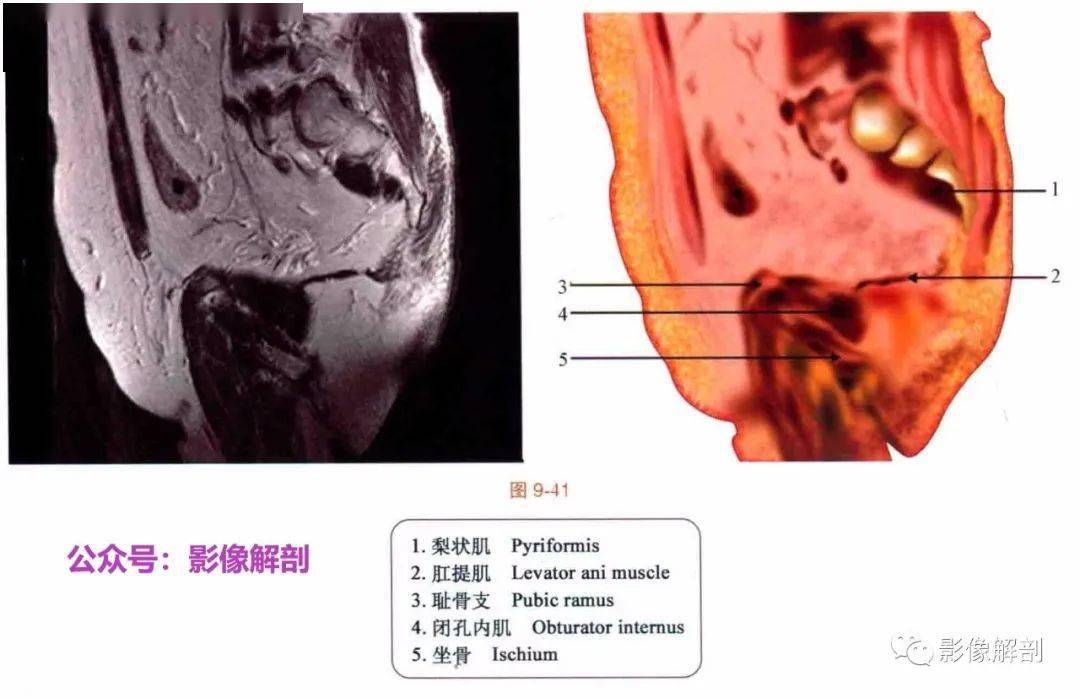 断层图谱 | 男,女性盆腔解剖图谱