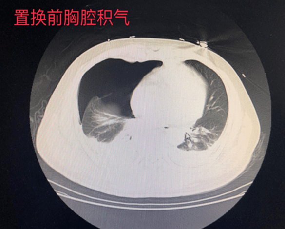 8后肋骨折内固定手术,以避免体位变动时发生血气胸的二次负损伤,再做