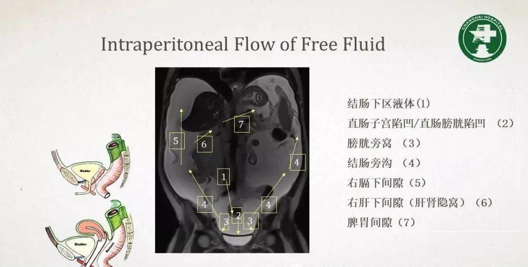 腹膜相关结构的影像解剖