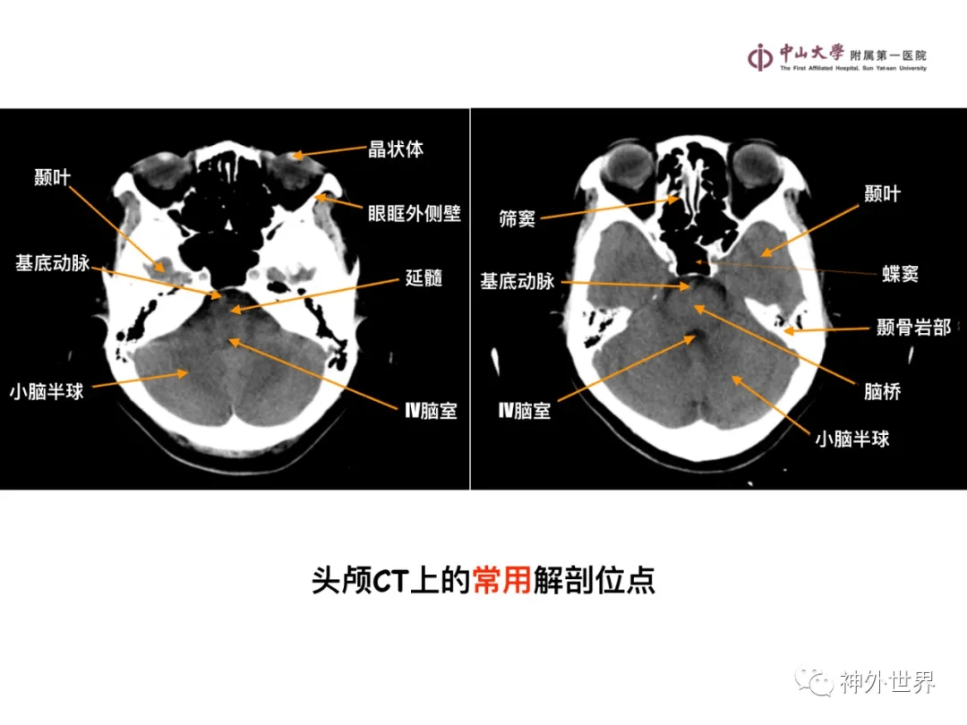 急诊头颅ct-"3b"阅片法,这个阅片法值得推荐