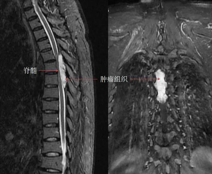 李涛仔细评估患者病情后认为,患者胸椎管内肿瘤组织侵及范围广,长达