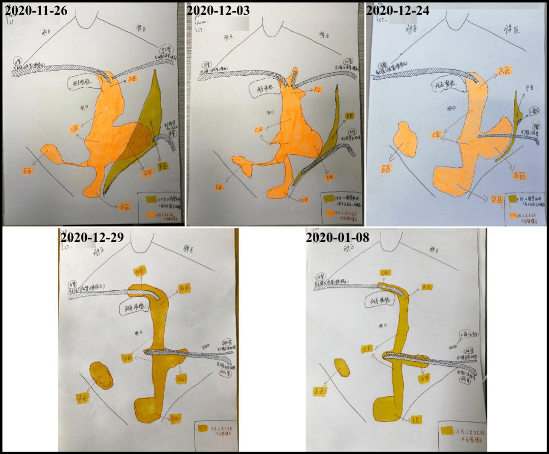 住院期间前后腹部ct手绘简化图