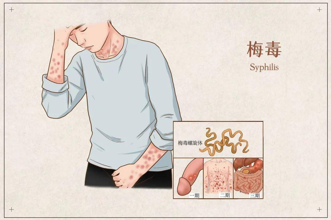 患者在性接触2-4周左右出现生殖器方面的溃疡(医学上叫"硬下疳");6-8