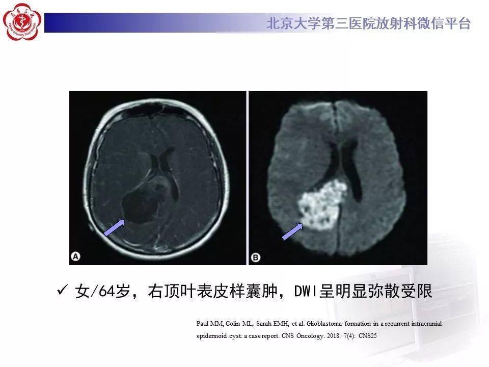 神经上皮囊肿影像表现