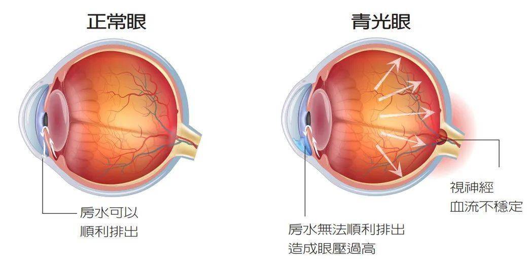 "这是典型的青光眼,房角已经大部分关闭,需要做手术.