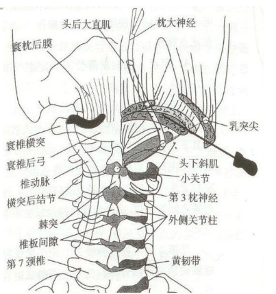 颈部软组织引起"枕大神经痛"原因及处理策略