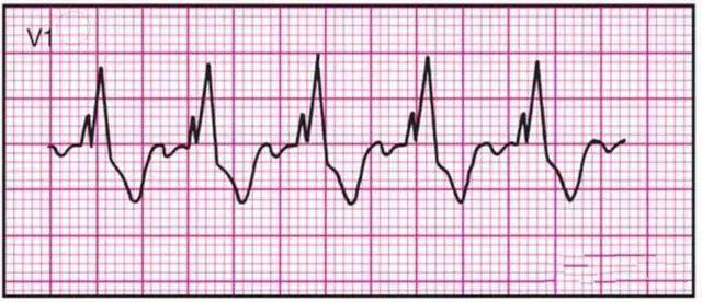 14种常见心电图波形的特点