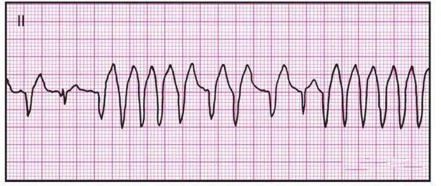 14种常见心电图波形的特点
