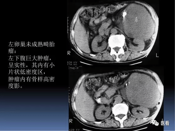 5大卵巢恶性肿瘤如何在ct上寻找蛛丝马迹医学影像经典ppt