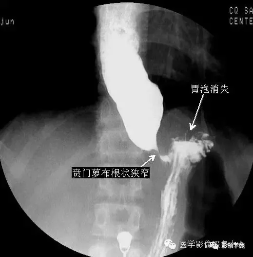 10种食管钡餐常见疾病图解  正常食管黏膜像 来源:影领学苑 【版权