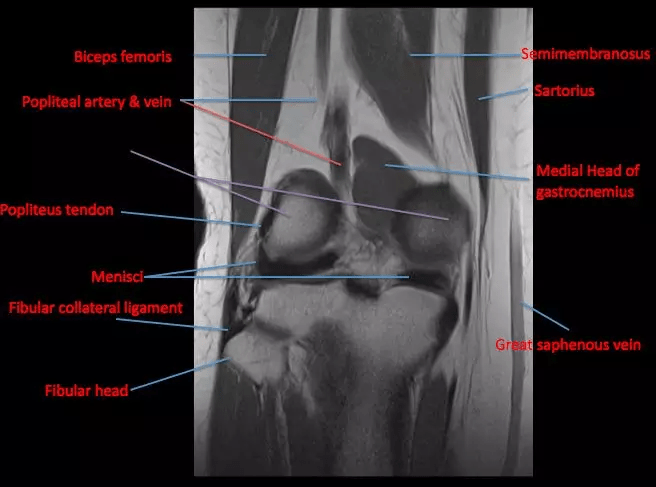 tendon腘肌肌腱, great saphenous vein大隐静脉, biceps femoris