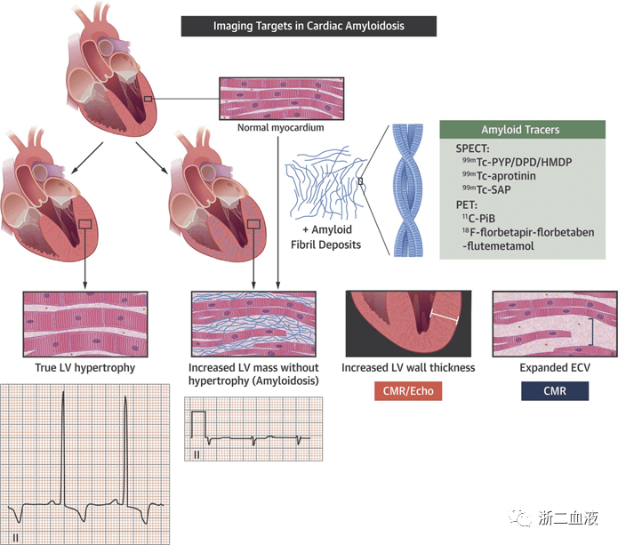 心内科医生看心脏淀粉样变_变性
