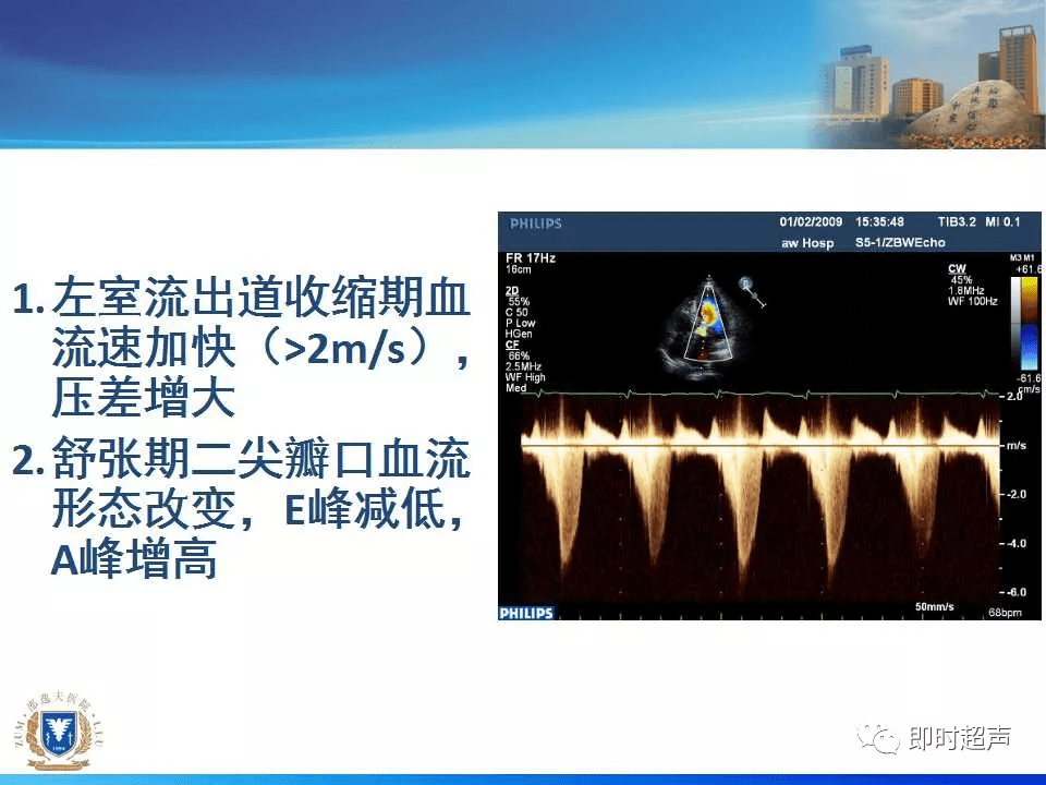 左室肥厚的超声心动图诊断思路