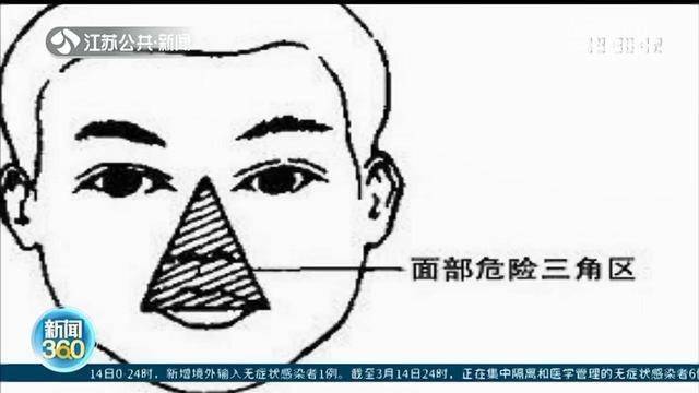 男子挤痘痘引发颅内脓肿导致瘫痪危险三角区别乱碰