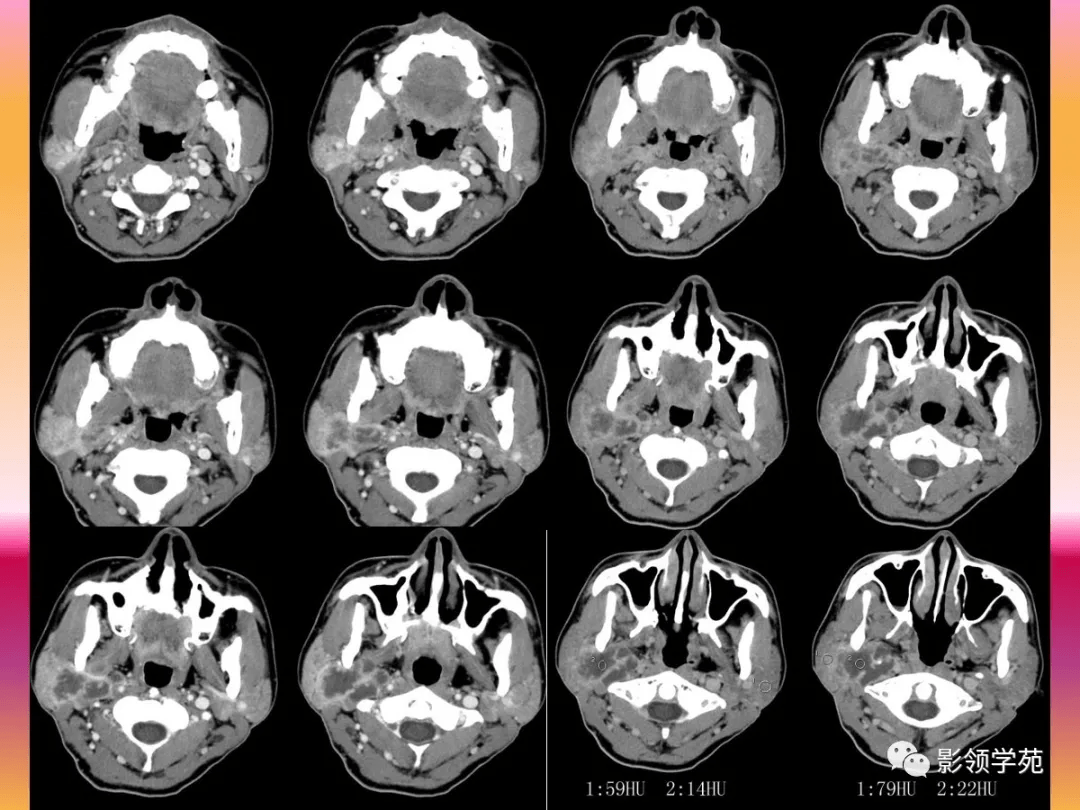 腮腺疾病的ct诊断与鉴别诊断