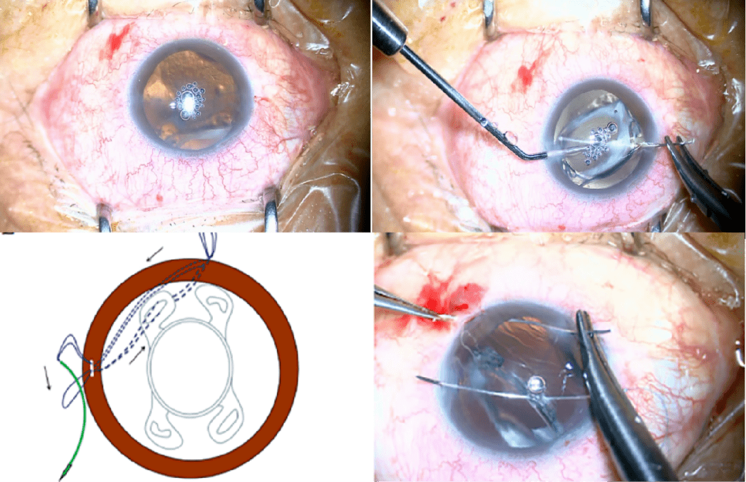 空中课堂第三十三期张宗端教授复杂人工晶状体后脱位的微创复位固定术