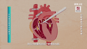 若常感疲劳可做超声心动图,超声心动图可准确筛查肥厚型心肌病.