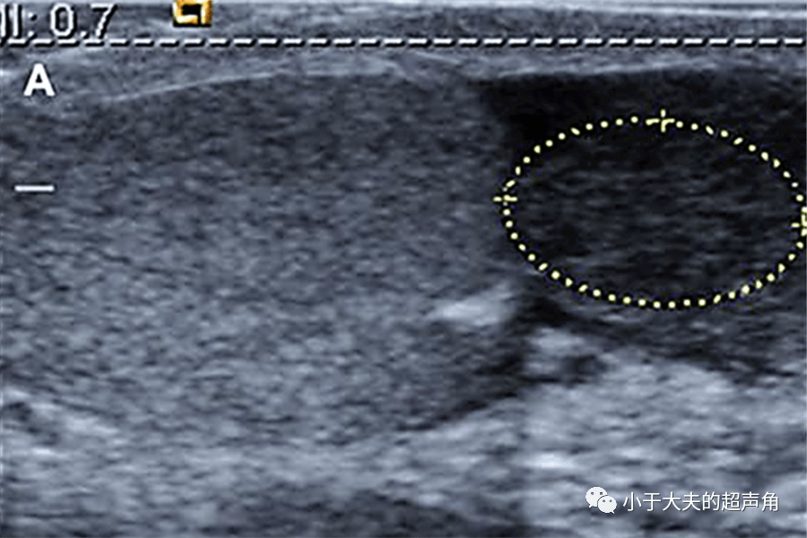 超声随响〗第58期 横纹肌肉瘤 - 小儿最常见的睾丸附属区恶性肿瘤