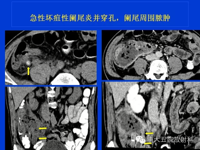 全面讲解正常阑尾和阑尾炎的ct表现