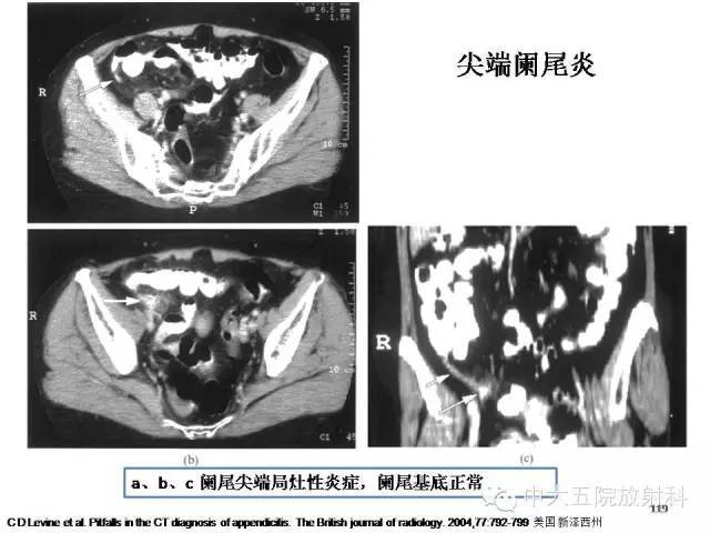 全面讲解 | 正常阑尾和阑尾炎的ct表现